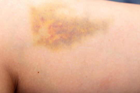 Bruises on the human body. Severe bruise from impact, bruising and hematoma.