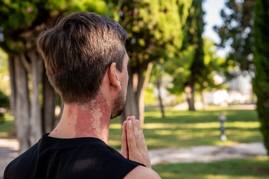 Man practicing yoga outdoors showing red birthmark on neck