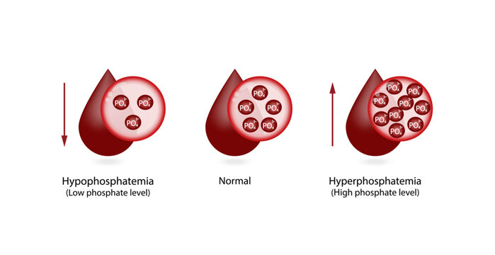 Hyperphosphatemia, high plasma phosphate level and Hypophosphatemia, low plasma phosphate level. phosphate excess and deficit electrolyte disorders, blood droplet, Scientific Vector illustration.