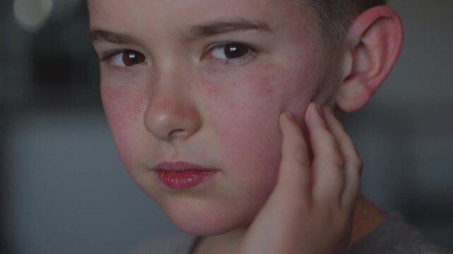 Boy Having Allergic Reaction on Skin to Food.	Boy Has Dry Red Skin and Scratching Her Face. Child Scratches Atopic Skin. Dermatitis, Diathesis, Allergy on Child Body and Face. Irritation and Pruritus.