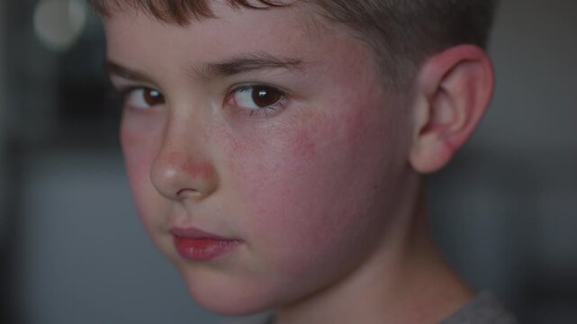 Boy Having Allergic Reaction on Skin to Food.	Boy Has Dry Red Skin and Scratching Her Face. Child Scratches Atopic Skin. Dermatitis, Diathesis, Allergy on Child Body and Face. Irritation and Pruritus.