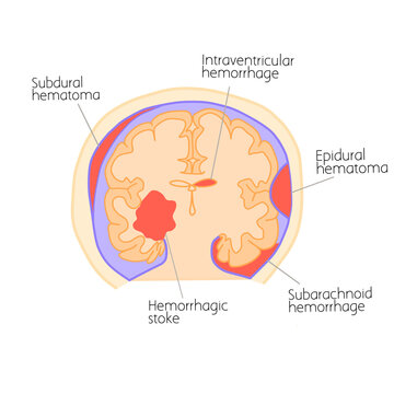 Intracranial hematomas