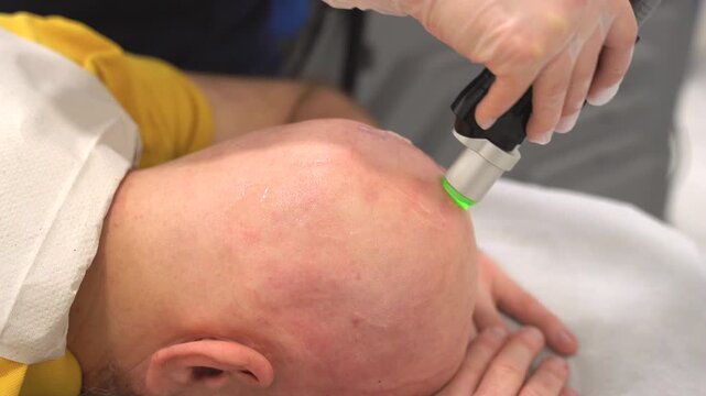 Professional laser hair removal session on a male head for smooth skin