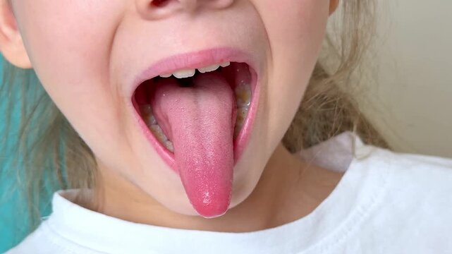 Close-up of little girl opening her mouth wide to the doctor to show her throat. Child is sitting with wide open mouth, with a tongue stuck out, clear view on the uvula and the soft palate