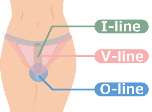 VIO脱毛のイラスト