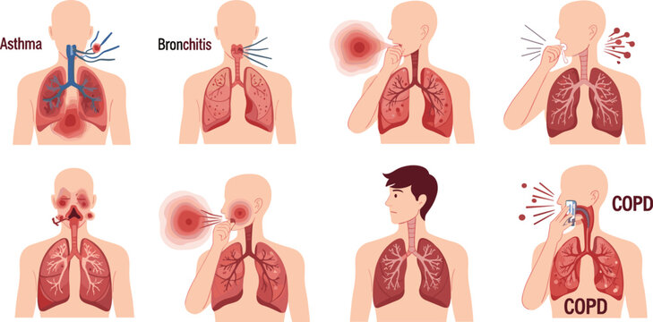Asthma, Bronchitis, and COPD Respiratory Diseases Illustration Showing Affected Lungs and Breathing Symptoms
