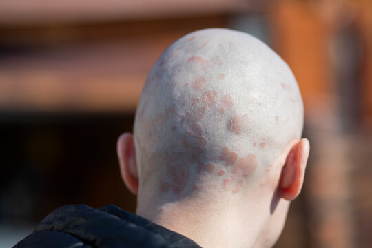 Back view of bald man with psoriasis on scalp. Skin rash and inflammation on head. Medical condition, autoimmune disease, dermatology and health problem concept for patients.