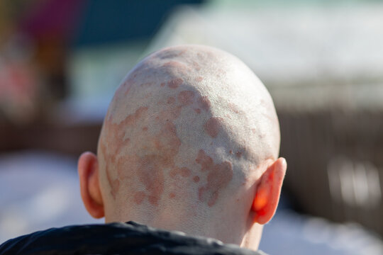 Man with psoriasis on the back of his scalp. Skin disease inflammation and dry red patch on head. Dermatological condition and health issue. Diagnosis of chronic autoimmune disorder.