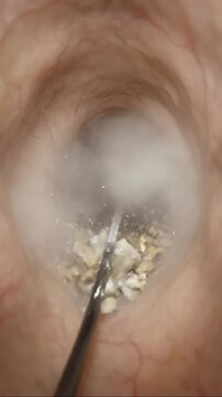 Extracted Kidney Stones of Human Urinary Tract During Laser Lithotripsy Medical Procedure, 3D Animation