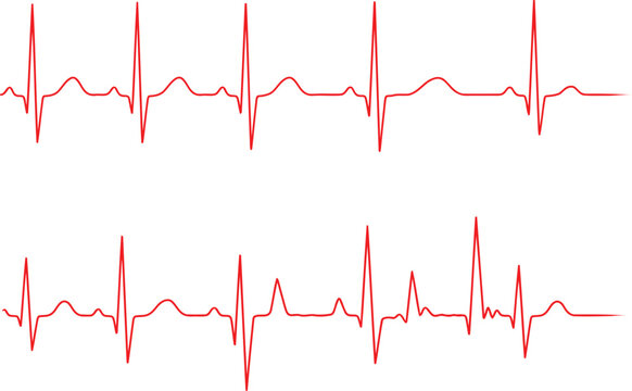 A comparison of a normal sinus heart rhythm and an irregular heartbeat on an electrocardiogram. Vector