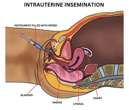 Intrauterine Insemination (IUI) Procedure Illustration &ndash; Assisted Reproductive Technology Diagram