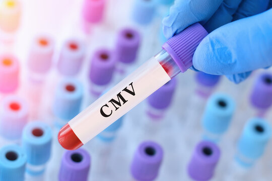 Doctor holding CMV blood test tube explaining detection of cytomegalovirus infection, immune response evaluation and viral diagnostics in clinical laboratory testing