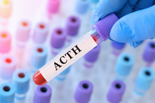 ACTH progesterone blood test for adrenal and pituitary hormone function assessment with doctor holding laboratory sample tube during endocrine diagnostics and clinical analysis copy space