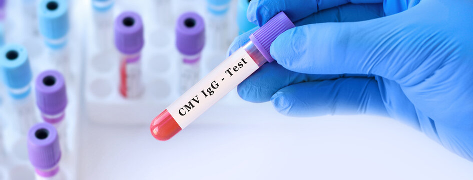 Doctor holding CMV blood test tube explaining detection of cytomegalovirus infection, immune response evaluation and viral diagnostics in clinical laboratory testing
