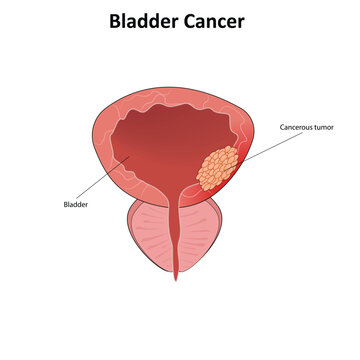 Bladder cancer vector illustrration