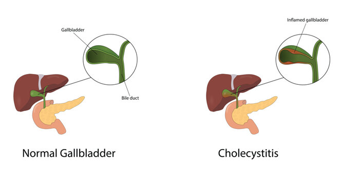 Cholecystitis vector illustration
