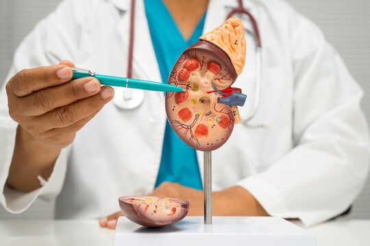 Chronic kidney disease, doctor with model for treatment urinary system, urology, Estimated glomerular filtration rate eGFR.