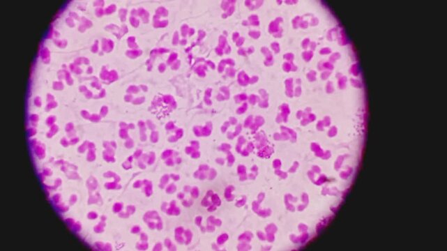 Microscopic footage of urethral smear for Gram stain. Gram negative intra and extracellular diplococci are seen. Plenty of pus cells are present.