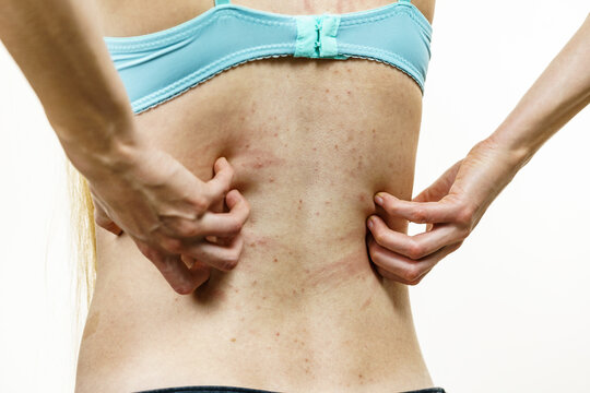 Woman scratching her itchy back with allergy rash