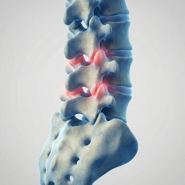 Spine Osteoarthritis Facet Joint Degeneration Semi Realistic Illustration
