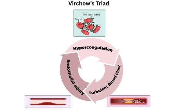 Virchow&rsquo;s Triad Medical Illustration &ndash; Risk Factors for Thrombosis Diagram