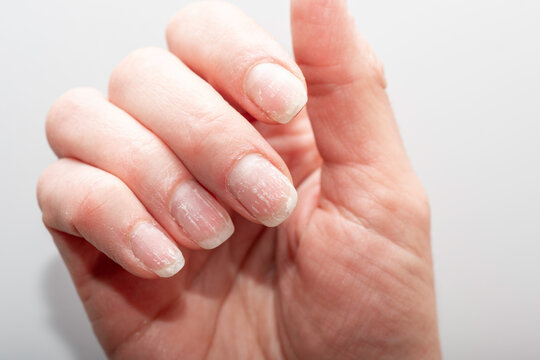 Close-up of damaged natural nails. A natural hand with problematic cuticles and broken nails. Emotional stress. Age-related skin changes. Hand care.