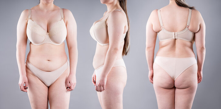 Plus size woman in lingerie. Front, side, rear views. Concept of weight loss, liposuction and body contouring
