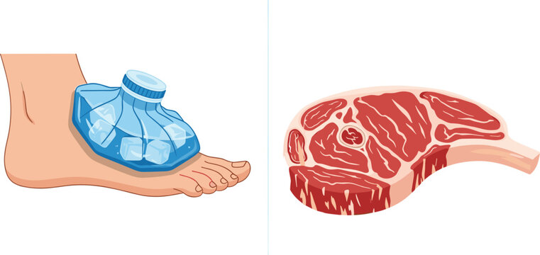 First aid ice pack on injured ankle with ice cubes and blue water bag alongside fresh raw beef steak with marble texture vector illustration.