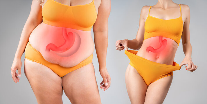 Before after weight loss transformation with bariatric surgery or gastric bypass. Overweight and slim woman with red stomach