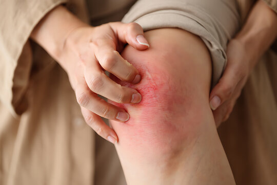 Person scratching red irritated skin on knee with fingers irritation rash