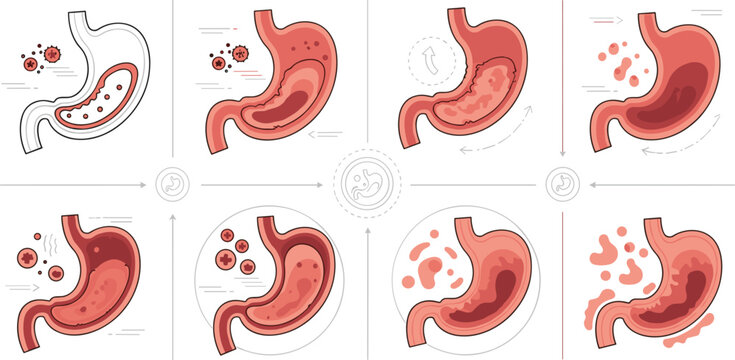 Progression of EMAG in Stomach Health Vector Set with Stomach Acid, Inflammation, and Affected Digestive Stages for Medical, Health, and Disease Prevention Design