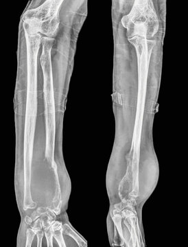 Bone cancer of the radius  X-ray
X-ray of the  patient  hand  with an aggressive bone tumour. The radius bone  contains lytic lesions,sugestive agresive bone tumour 
