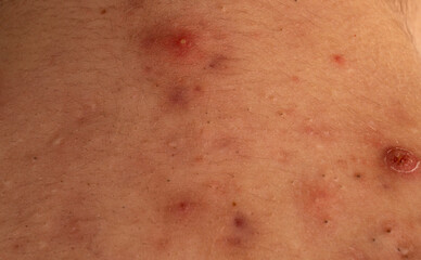 Fototapeta premium Pimple macro close up for skincare texture detail. Pimple close up pores and sebum on skin. Pimple acne macro with whitehead comedone and blemish. Pimple macro for dermatology background.