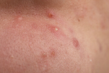 Fototapeta premium Pimple on human skin with follicles and irritation. Acne with comedone and whiteheads in pores. Macro detail of acne and inflamed epidermis. Skincare derma concept for pimple.