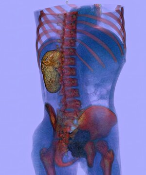 3D abdominal CT reconstruction demonstrating unilateral renal agenesis with absence of one kidney and compensatory contralateral renal anatomy, relevant for congenital urogenital anomaly evaluation