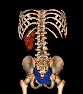 3D abdominal CT reconstruction demonstrating unilateral renal agenesis with absence of one kidney and compensatory contralateral renal anatomy, relevant for congenital urogenital anomaly evaluation