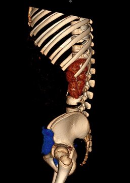 3D abdominal CT reconstruction demonstrating unilateral renal agenesis with absence of one kidney and compensatory contralateral renal anatomy, relevant for congenital urogenital anomaly evaluation