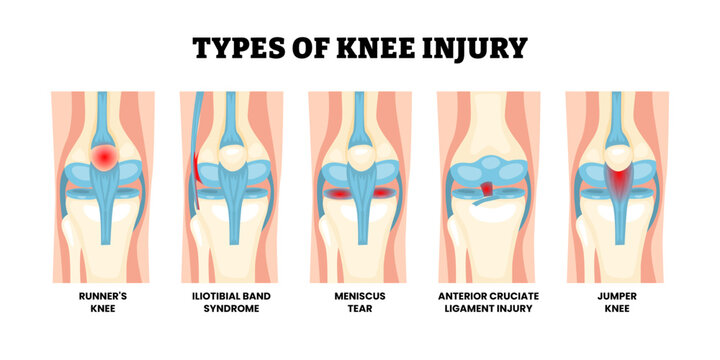 Different types of knee injury types. Labeled runners knee, iliotibial band syndrome, meniscus tear, anterior cruciate ligament injury, and jumper knee. Knee anatomy structure front view illustration.