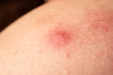 Fototapeta premium Acne skin pimple. Skin problem with inflamed bumps. Irritated skin texture. Close up skin issue.