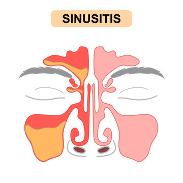 Sinusitis Medical Illustration Showing Healthy vs Inflamed Paranasal Sinuses with Frontal, Ethmoid, and Maxillary Sinus Anatomy, Mucus Buildup. Vector for poster, science and education.