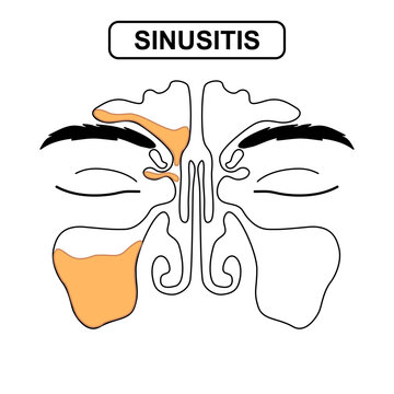 Sinusitis Medical Illustration Showing Healthy vs Inflamed Paranasal Sinuses with Frontal, Ethmoid, and Maxillary Sinus Anatomy, Mucus Buildup. Vector line drawing for poster, science and education.	
