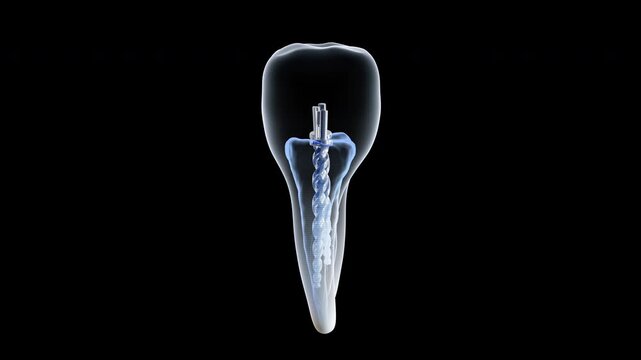 3d tooth animation. Isolated rotating 3d tooth model. filling and pin in the tooth. Soaring beautiful white dental 3d rendering.