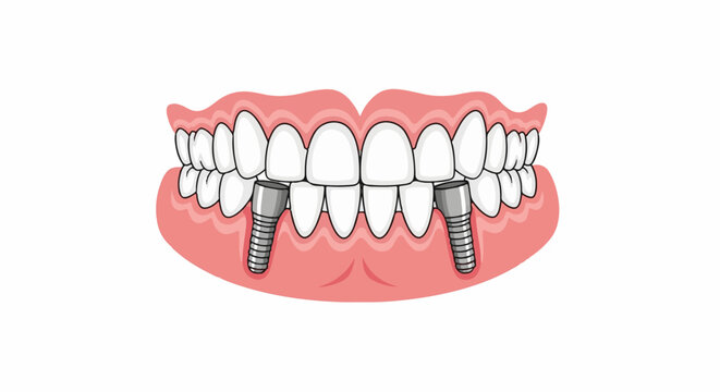 Dental implants shown in a cartoonish illustration of gums and teeth