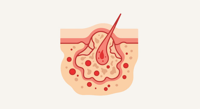 Diagram of a pore with a hair follicle and oil glands, showing inflammation