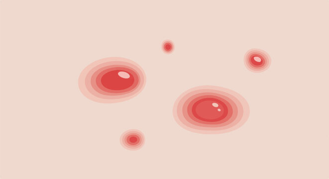 Close-up of skin with several red, inflamed blemishes