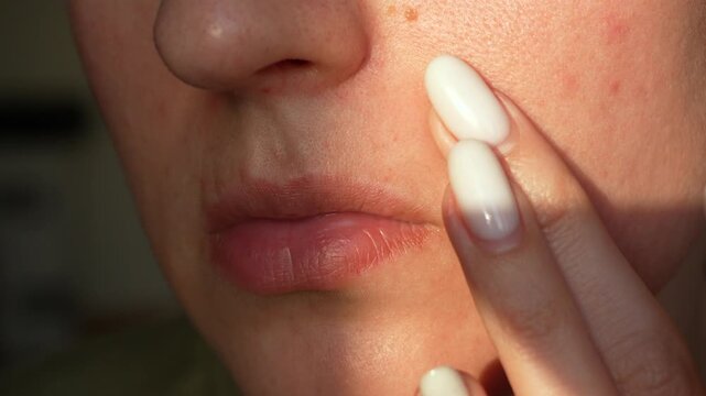 Close up of young woman face with acne, pimples and skin texture in natural light. Skincare concept, dermatology, problematic skin and beauty without retouching.