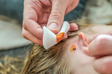 Disinfecting an embedded and blood-sucking tick behind a child's ear before removing it with tweezers.