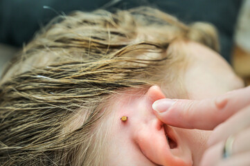 finding a bitten and blood-sucking tick behind a child's ear.