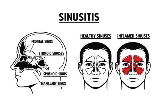 Comparison of healthy and inflamed sinuses in sinusitis condition Vector