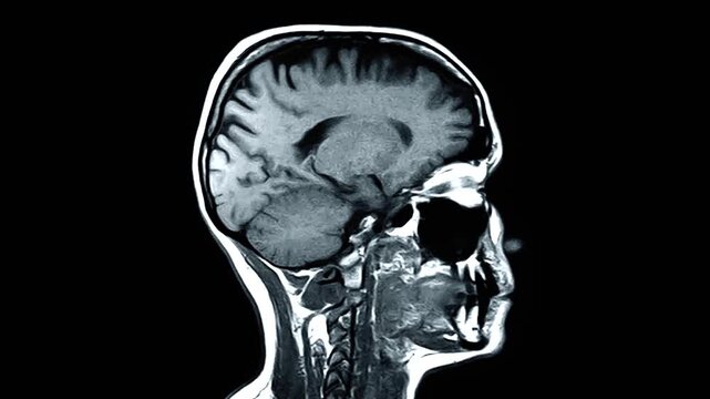 MRI image of the human brain on a black background. Magnetic resonance imaging for brain diagnosis in high contrast. Right side fast animated lateral brain scan